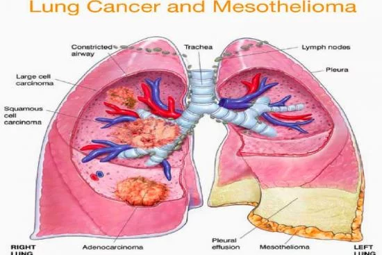 Treatment Options for Pleural Mesothelioma in Turkey 2024