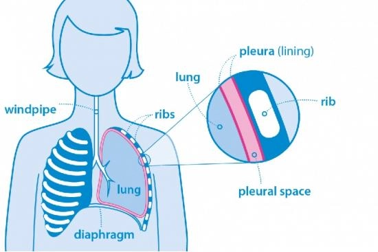 Tratamiento del mesotelioma pleural Turquía 