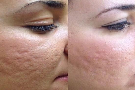 of our patients 2 mesotherapy, session, price, Turkey, mesopecie, mesolift