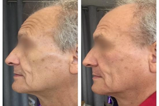 of our patients 1 mesotherapy, session, price, Turkey, mesopecie, mesolift