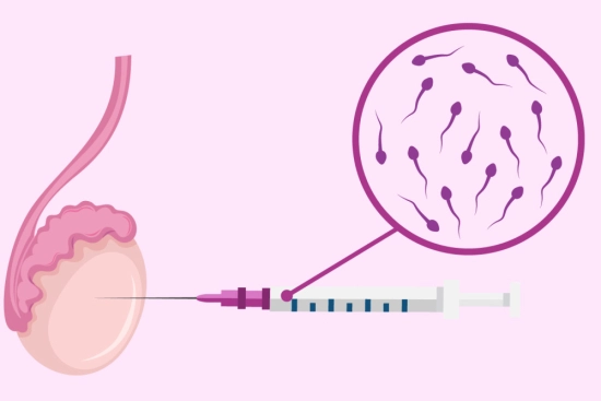 Diagnostic précédant une micro-TESE 2025