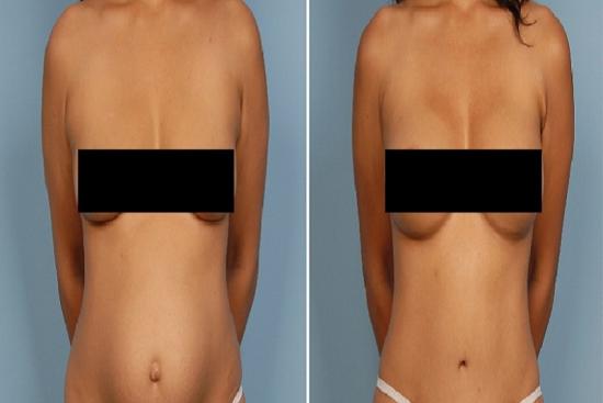  Photos: Before / After 0 in Turkey Mommy makeover, turkey, price, cost, reviews, doctor, clinic