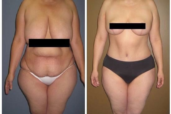 Mommy Makeover Before / After Women