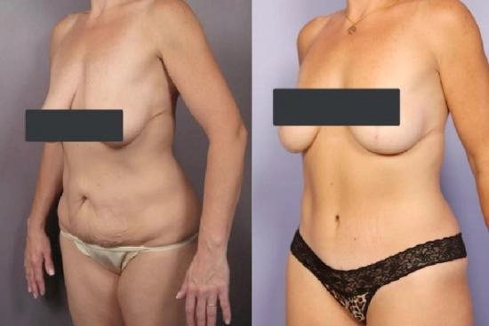 Best Mommy Makeover prices