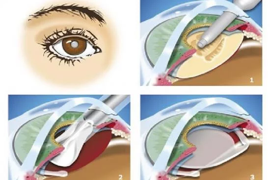 Лечение катаракты Турция 