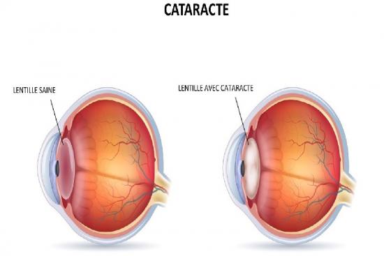 Cataract Surgery Turkey Istanbul Top 3 Clinics Andprices