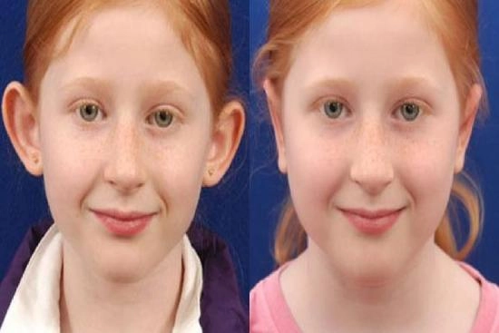 لمرضانا 0 الأذن الخفاشية,تجميل الأذن البارزة,سعر عملية تجميل الأذن,تركيا