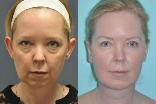 of our patients 1 otoplasty, turkey, price, earfold