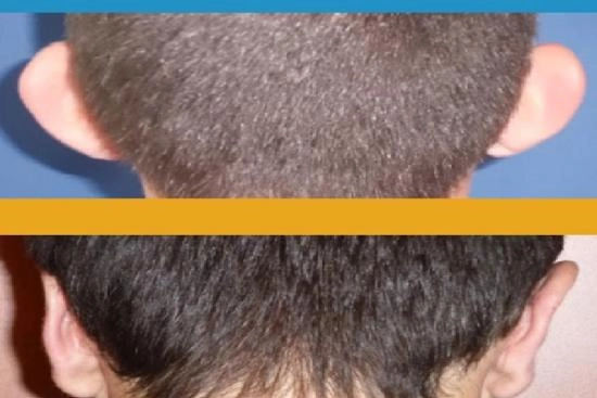 of our patients 3 otoplasty, turkey, price, earfold