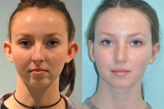 of our patients 2 otoplasty, turkey, price, earfold