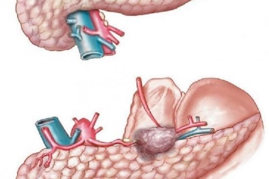 Total pancreatectomy Turkey 