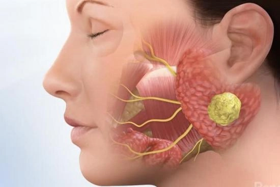 Removal of Salivary Gland Tumor Turkey 