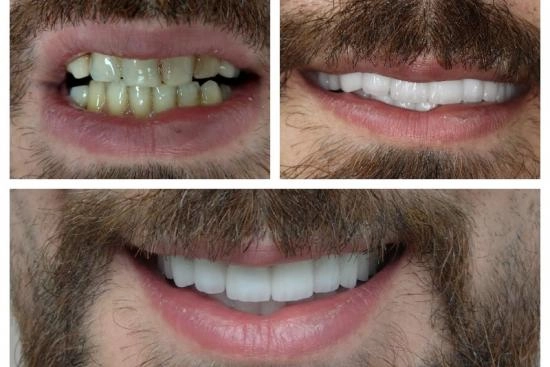 of our patients 3 laminate veneers, price, Turkey