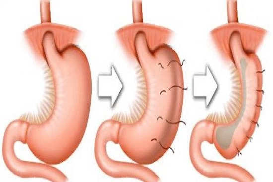 Endoscopic Gastric Plication Turkey 