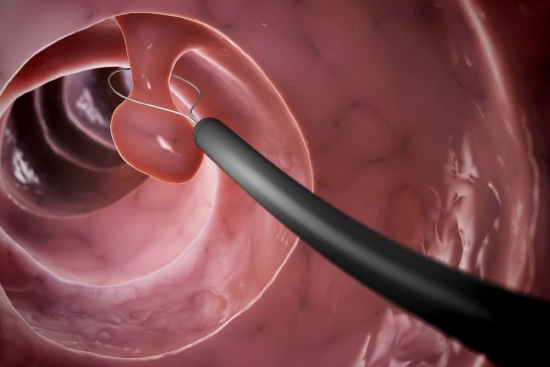 Polypectomy: Treatment of nasal polyposis in Turkey