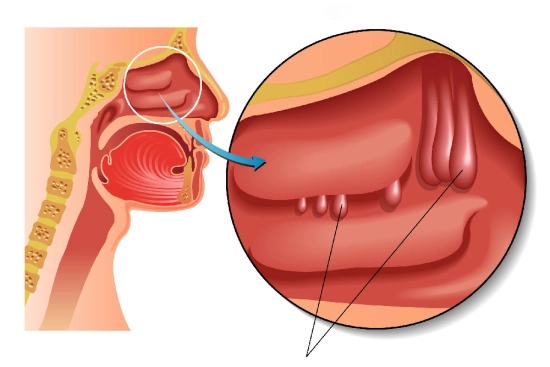 Causes des polypes nasaux Causes des polypes nasaux