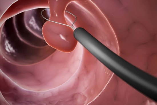 Какие симптомы указывают на полипы в носу? 2026 Какие симптомы указывают на полипы в носу? 2026
