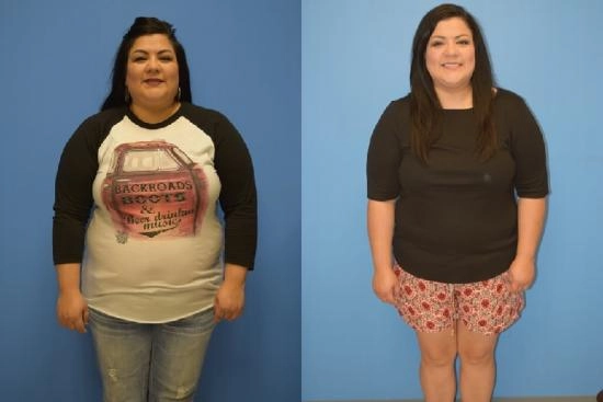 of our patients 2 Stomach, adjustable gastric band, price, doctor, turkey, clinic