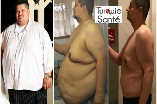 of our patients 1 Stomach, adjustable gastric band, price, doctor, turkey, clinic
