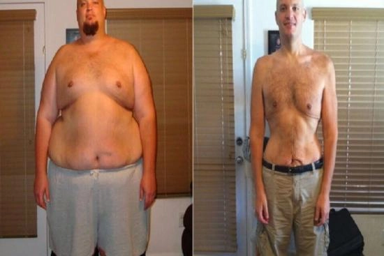 of our patients 4 Stomach, adjustable gastric band, price, doctor, turkey, clinic