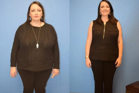 of our patients 3 Stomach, adjustable gastric band, price, doctor, turkey, clinic