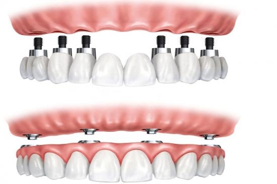 Dental prosthesis Turkey 