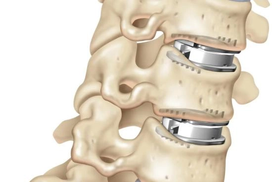 Disc replacement surgery in Turkey