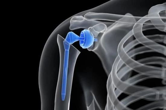 Shoulder prosthesis: An overview 2024