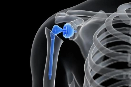 Shoulder replacement prosthesis: An overview 2025