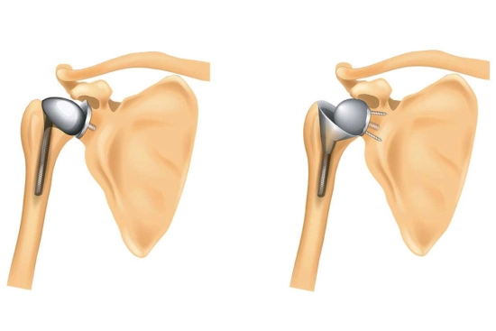 Types de prothèse d'épaule à Istanbul Turquie 2026