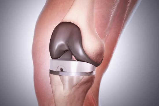 Knee replacement surgery in Turkey