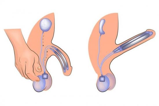 Penile implant