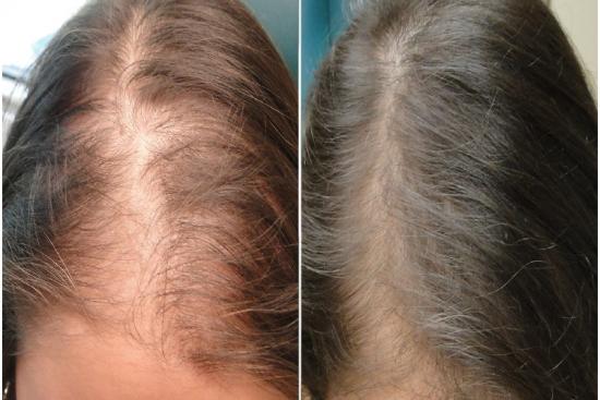  Photos: Before / After 0 in Turkey treatment,prp therapy,therapy,cost,prp for hair loss: results,results,turkey,istanbul,clinic,hospital,doctor