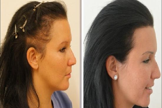 PRP Hair Loss treatment cost in Turkey | Clinics & Reviews