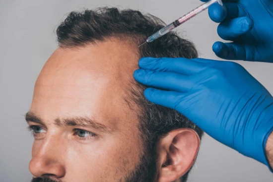 What is PRP hair treatment? 2025