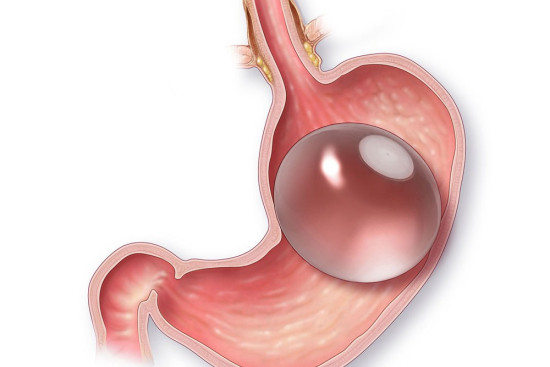 Gastric balloon