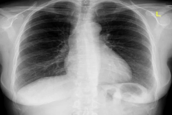 Radiographie pulmonaire 
