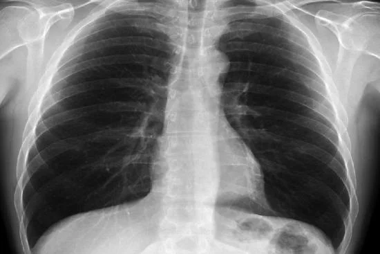 Radiographie pulmonaire 