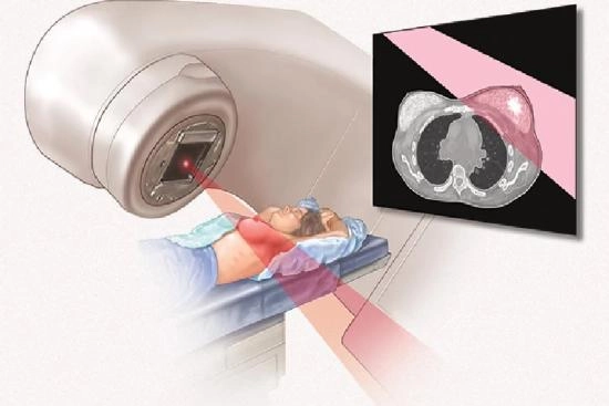 Types of Radiation Therapy 2024