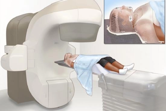 Preparing for radiotherapy: steps to follow 2025