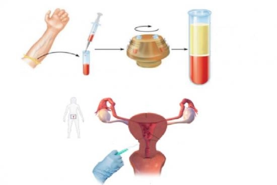 Rajeunissement ovarien avec PRP 