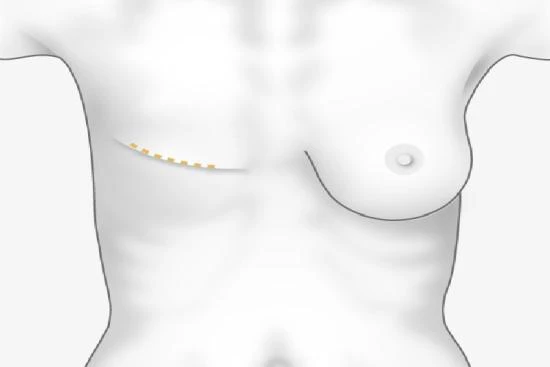 Reconstruction mammaire 