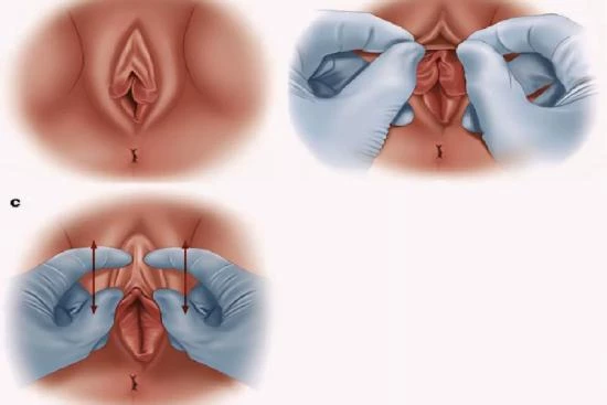 processus de réduction du capuchon clitoridien