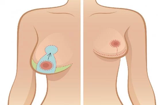 Réduction mammaire 
