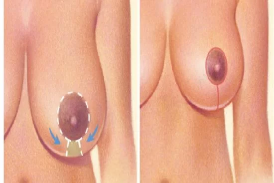 Gynecomastia: The male mammary gland reduction surgery 2024