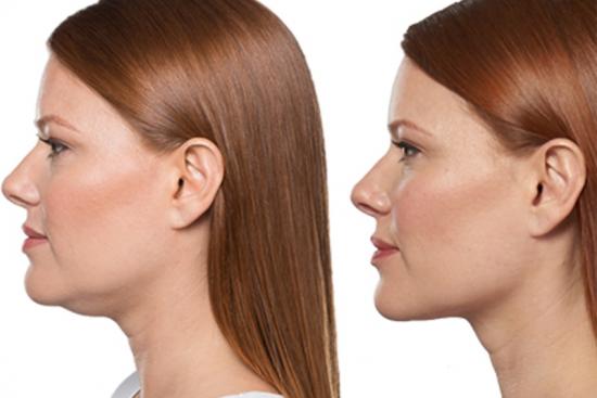  Photos: Before / After 0 in Turkey double chin reduction in turkey,double,surgery,cost,best double chin treatment,best,treatment,non surgical chin reduction,non invasive chin reduction,non surgical,non invasive,jaw,price,plastic