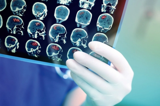 Stroke diagnosis and symptoms 2026 Stroke diagnosis and symptoms 2026