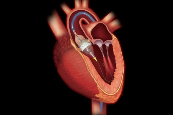 Risks and potential complications of TAVI 2026