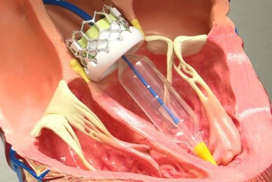 Remplacement valvulaire aortique par voie transcathéter (TAVI) 