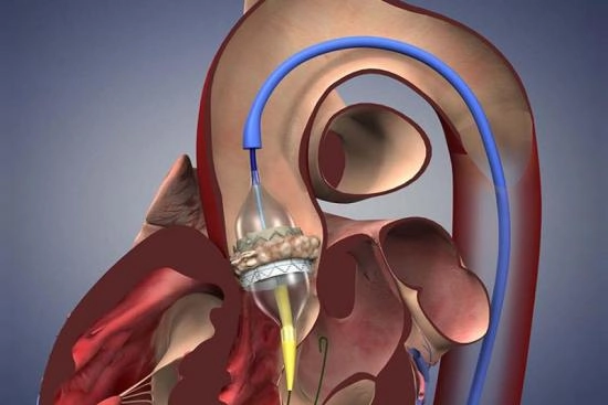 Remplacement valvulaire aortique par voie transcathéter (TAVI) 